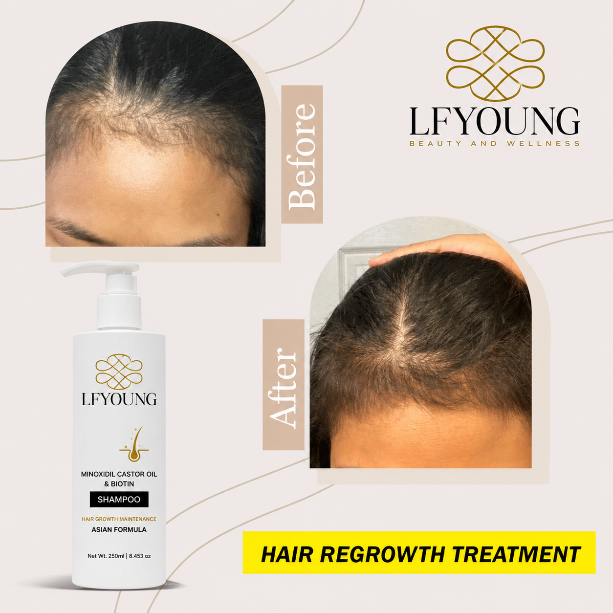 LFYoung Minoxidil Hair Grower Shampoo with Biotin and Castor Oil 250mL for Hair Loss Treatment Anti Dandruff FDA Approved
